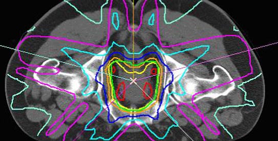 prostate-cancer-E543