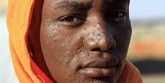 Global health partnership targets neglected diseases