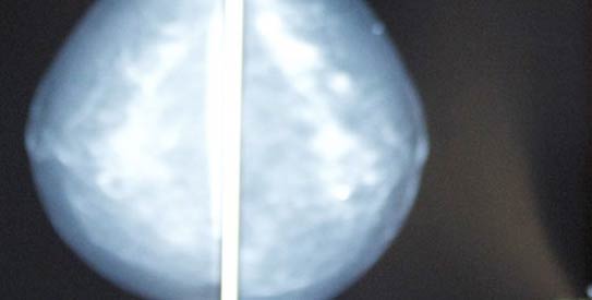 Mammogram-R543