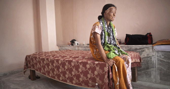 Sonali Mukherjee, 27, sits in a room temporarily offered by a Sikh temple during an interview in New Delhi July 22, 2012. Mukherjee is appealing to the Indian government for medical support for skin reconstructive surgery as well as tougher penalties on her three assailants, who were released on bail after only three years in prison. Picture taken July 22, 2012. REUTERS/Ahmad Masood (INDIA - Tags: SOCIETY HEALTH CRIME LAW)