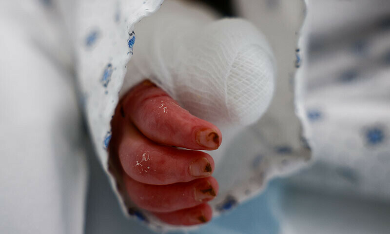The hand of a two-year-old Ivana Skayki, who suffered third-degree burns over nearly half of her body from an Israeli strike in southern Lebanon, is pictured as she lies in bed at Geitaoui Hospital in Beirut, Lebanon, October 30. — Reuters