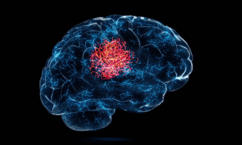   مسلسل سر درد جو لوگ عموماً خطرناک عارضے کی علامت کے طور پر لیتے ہیں  