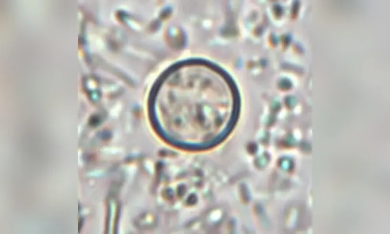 What to know about the US outbreak of cyclospora parasite intestinal illness