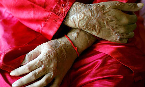 Kaneez Fatima — whom acid could not silence