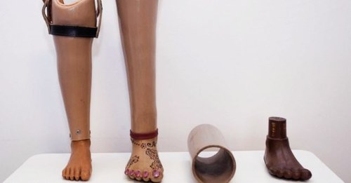 Free artificial limbs facility launched Free artificial limbs facility launched