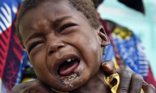 Malnutrition brings a terrible disease to children in Niger