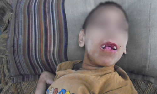 Deformities in Charsadda: Cousin marriages, and the heavy price children pay