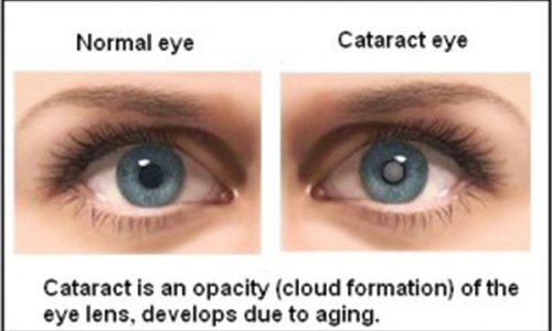 Cloudy vision! Cloudy vision!