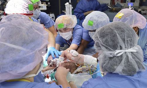 Swiss doctors separate 8-day-old conjoined twins, says report