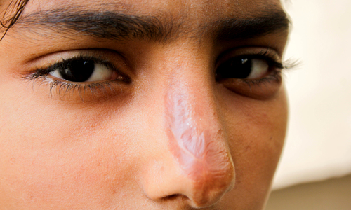 Man throws acid on younger brother in dispute over cellphone charger