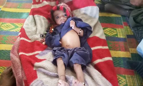 Up to 65% children acutely malnourished in parts of Quetta: Unicef official