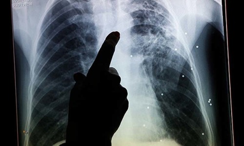Punjab fails in fight against TB