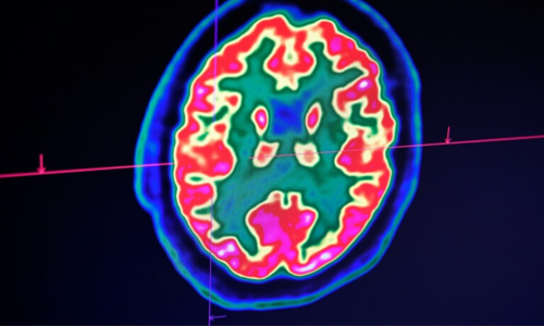 How Covid-19 might increase risk of memory loss and cognitive decline