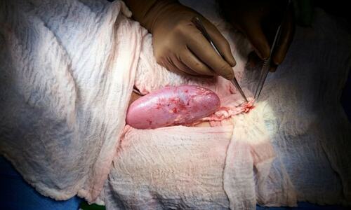Pig&rsquo;s kidney given to brain-dead human in US