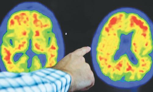 Alzheimer’s diagnosis revamp embraces rating scale similar to cancer Alzheimer’s diagnosis revamp embraces rating scale similar to cancer