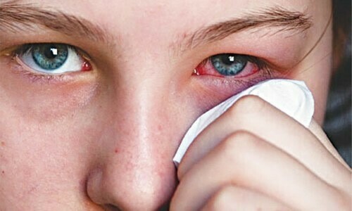Weather condition, poor sanitation leading to rise in eye infection cases across Karachi