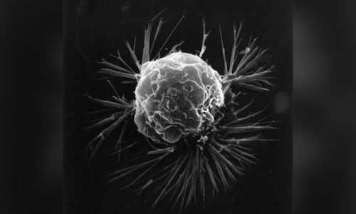 &lsquo;Anticipatory grief&rsquo; &mdash; cancer&rsquo;s untold mental health toll