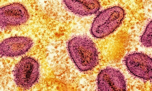 New mpox variant detected in Germany: health authority