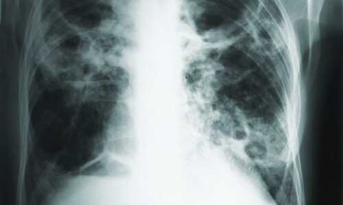 Tuberculosis cases hit record 8.2m high in 2023: WHO Tuberculosis cases hit record 8.2m high in 2023: WHO