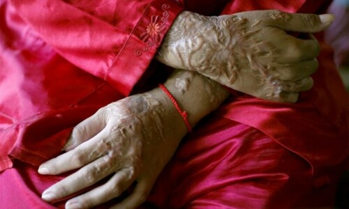 Multan man throws acid on wife, children in domestic dispute Multan man throws acid on wife, children in domestic dispute