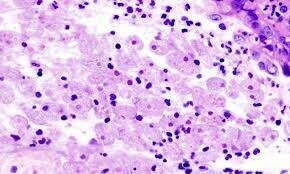Karachi records first Naegleria death of 2025 Karachi records first Naegleria death of 2025