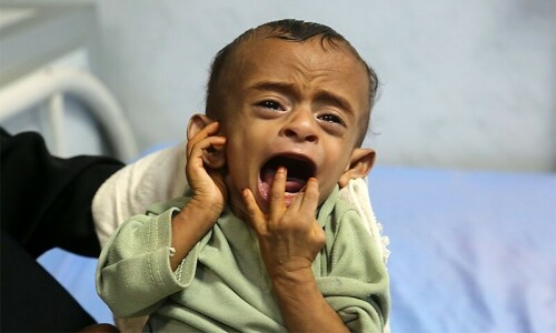Half of Yemen’s under-fives acutely malnourished: UN Half of Yemen’s under-fives acutely malnourished: UN