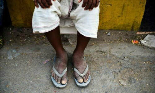 Over 5,000 children treated for foot deformity at Peshawar paraplegic centre