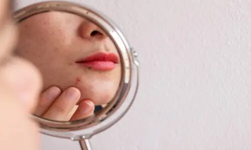 How PCOS affects the skin How PCOS affects the skin
