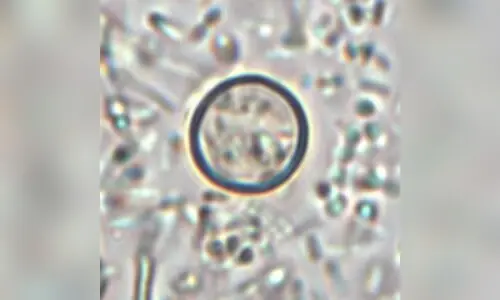 What to know about the US outbreak of cyclospora parasite intestinal illness