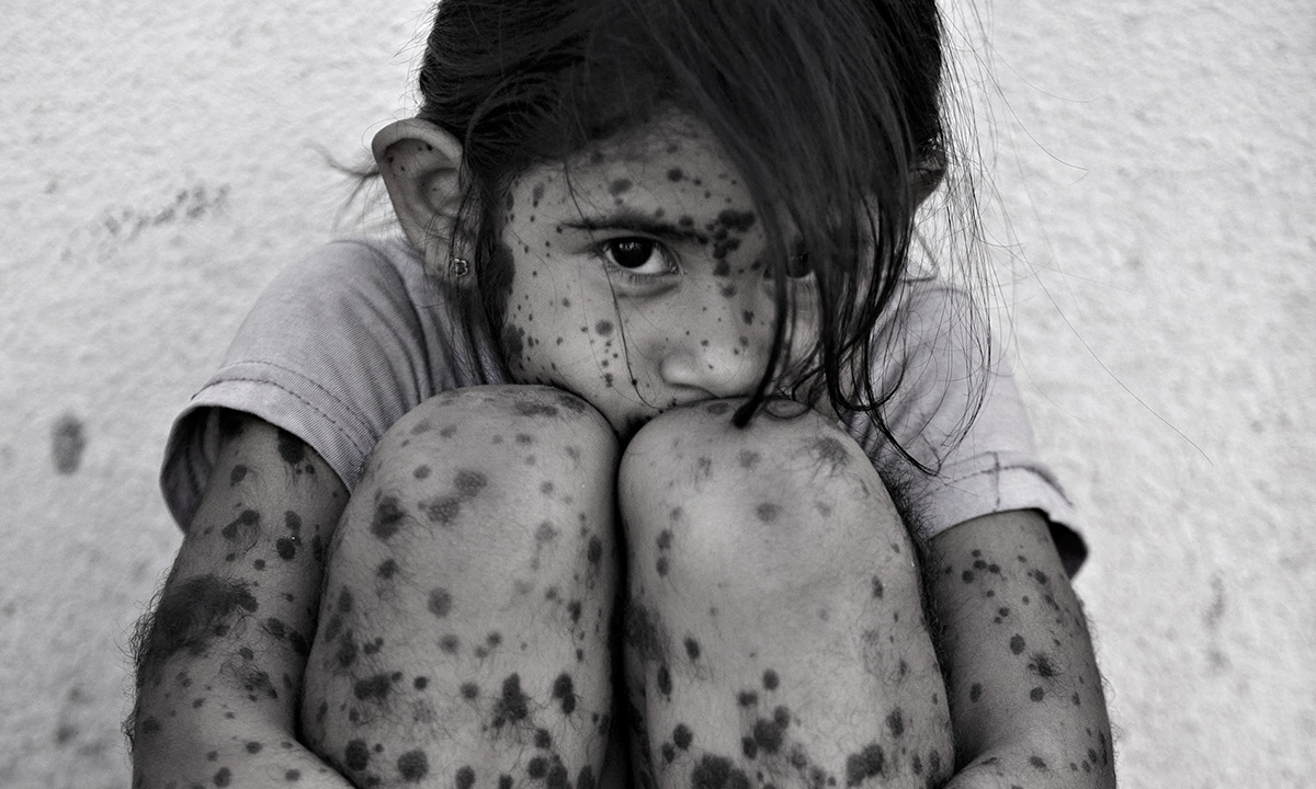 Aixa Cano, 5, who has hairy moles all over her body that doctors can't explain, sits on a stoop outside her home in Avia Terai, in Chaco province, Argentina. Although it’s nearly impossible to prove, doctors say Aixa’s birth defect may be linked to agrochemicals. In Chaco, children are four times more likely to be born with devastating birth defects since biotechnology dramatically expanded farming in Argentina. Chemicals routinely contaminate homes, classrooms and drinking water. - AP Photo
