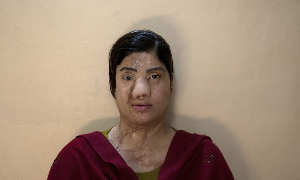 In this picture  acid attack survivor Kanwal Qayyoum, 29 underwent reconstructive surgery. She was doused in acid after telling a jealous former friend that she was starting a new job as an air hostess. &mdash; AP