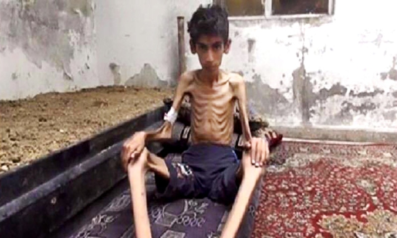 This undated photo posted on the Local Revolutionary Council in Madaya, which has been verified and is consistent with other AP reporting, shows a starving boy in Madaya, Syria.—AP