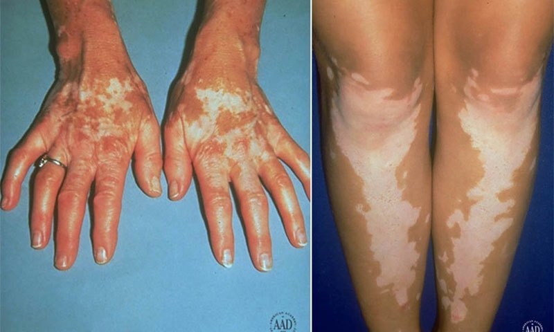 — فوٹو بشکریہ AMERICAN ACADEMY OF DERMATOLOGY — فوٹو بشکریہ AMERICAN ACADEMY OF DERMATOLOGY