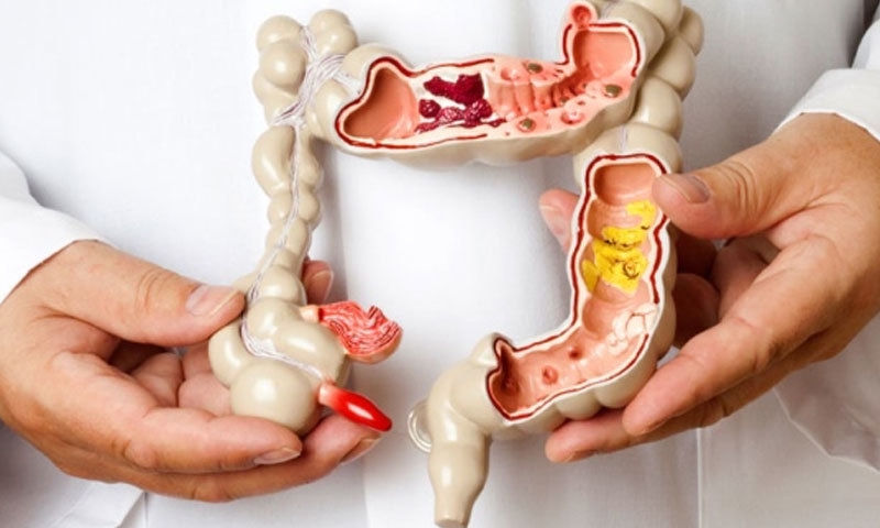 نظام ہاضمہ کی خرابی اور مسائل کا تعلق خطرناک بیماری سے ہے، رپورٹ&mdash;فوٹو: سی ٹی وی نیوز