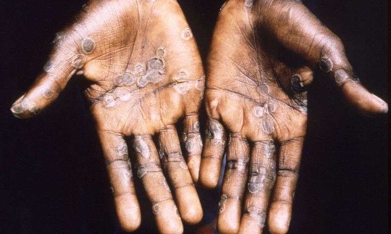 The palms of a monkeypox case patient from Lodja, a city located within the Katako-Kombe Health Zone, are seen during a health investigation in the Democratic Republic of Congo in 1997. — Reuters/File