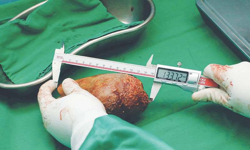 A MILITARY medical officer in Colombo measures the kidney stone removed from a retired soldier. It weighed 801 grams and measured 13.37 centimetres long.—AFP A MILITARY medical officer in Colombo measures the kidney stone removed from a retired soldier. It weighed 801 grams and measured 13.37 centimetres long.—AFP