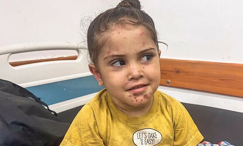 A Palestinian girl with a skin disease looks on as she receives treatment at Nasser hospital, amid Israel-Hamas conflict, in Khan Younis in the southern Gaza Strip July 29, 2024 &mdash; Reuters