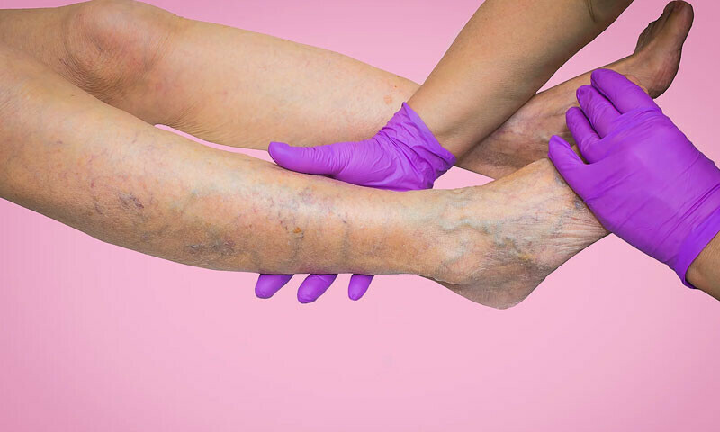 —فوٹو: veincenter —فوٹو: veincenter