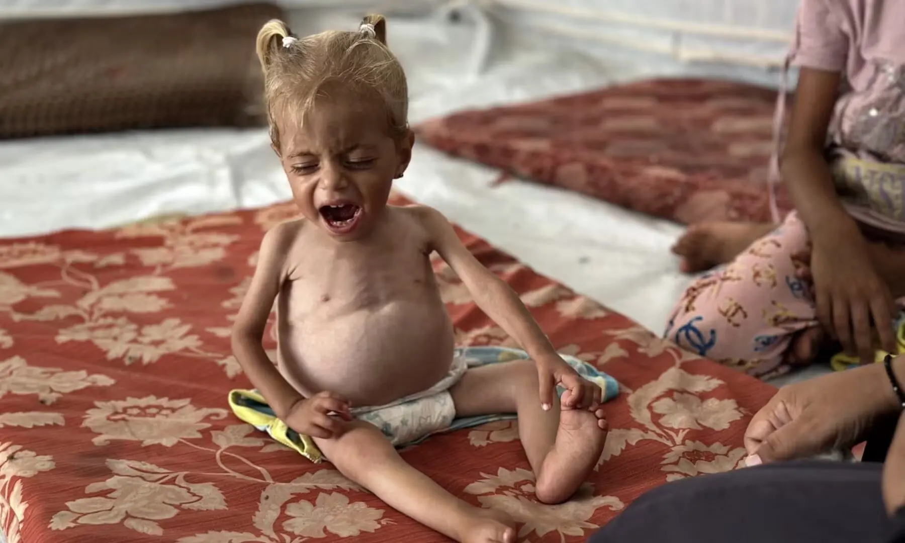   Sham Qadeh, a 22-month-old Palestinian girl suffering from severe malnutrition and an enlarged liver, is pictured with her mom in a makeshift tent on June 28 in Khan Younis, Gaza. — Anadolu Agency  