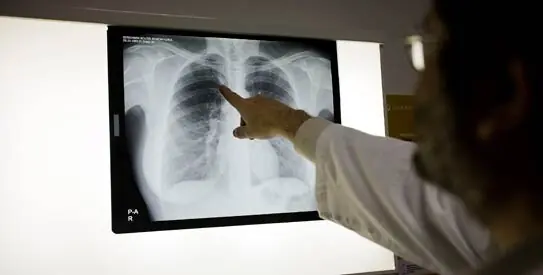 A physician looking at the X-Ray of TB patient. &ndash; Photo by SINC via Eureka Alert/File