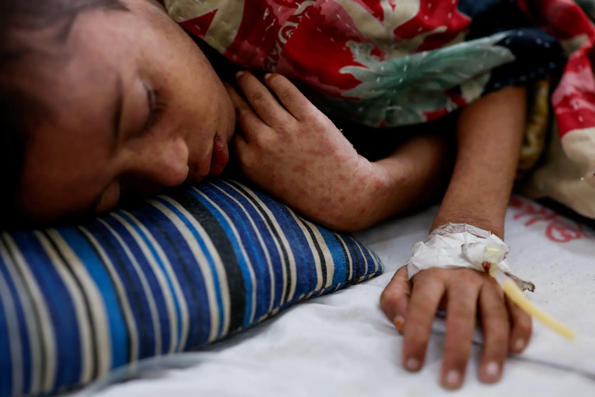 Masum, 8, receives treatment at the overcrowded measles isolation ward of Shahid Shamsuddin Ahmed Hospital after developing symptoms of measles, in Sylhet, Bangladesh, September 12, 2026.-Reuters Masum, 8, receives treatment at the overcrowded measles isolation ward of Shahid Shamsuddin Ahmed Hospital after developing symptoms of measles, in Sylhet, Bangladesh, September 12, 2026.-Reuters