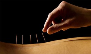 آکوپنکچر کا 'راز' سامنے آگیا
