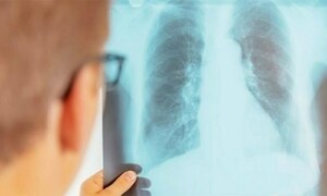 کووڈ 19 کے باعث دنیا بھر میں ٹی بی سے اموات میں اضافہ، ڈبلیو ایچ او