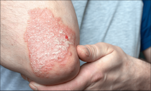 چنبل: خارش زدہ سرخ دھبوں کی اذیت ناک بیماری کا کیا علاج ہے؟