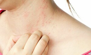 ذہنی دباؤ سے جسم پر سرخ دانے نکلنے کا انکشاف