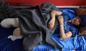 &lsquo;I want my legs back&rsquo;: the child amputees of Gaza&rsquo;s war