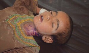 دنیا کی 50 فیصد آبادی خسرہ سے متاثر ہونے کا خدشہ ہے، عالمی ادارہ صحت