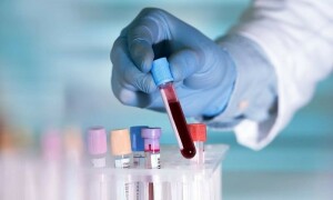 بلڈ ٹیسٹ سے 60 سے زائد بیماریوں کی تشخیص کا طریقہ دریافت
