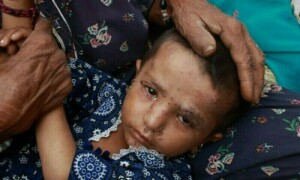 کراچی میں خسرہ پھر زور پکڑ گیا، سرکاری ہسپتالوں میں درجنوں بچے داخل