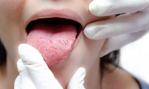 منہ کے عام جراثیم دل کے امراض کو بڑھا سکتے ہیں، تحقیق